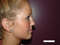Rhinoplasty Before Photo by Moneer Jaibaji, MD; Coronado, CA - Case 20282