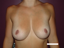 Breast Reduction After Photo by Moneer Jaibaji, MD; Coronado, CA - Case 20284