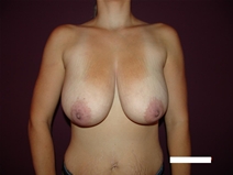 Breast Reduction Before Photo by Moneer Jaibaji, MD; Coronado, CA - Case 20284