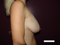 Breast Reduction Before Photo by Moneer Jaibaji, MD; Coronado, CA - Case 20284