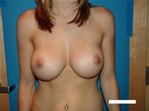 Breast Augmentation After Photo by Moneer Jaibaji, MD; Coronado, CA - Case 20288