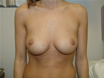Breast Augmentation Before Photo by Moneer Jaibaji, MD; Coronado, CA - Case 20288