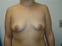 Breast Augmentation Before Photo by Moneer Jaibaji, MD; Coronado, CA - Case 20290