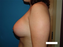 Breast Augmentation After Photo by Moneer Jaibaji, MD; Coronado, CA - Case 20290