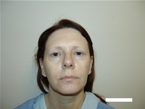 Facelift Before Photo by Moneer Jaibaji, MD; Coronado, CA - Case 20293
