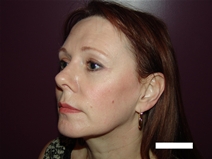 Facelift After Photo by Moneer Jaibaji, MD; Coronado, CA - Case 20293