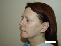 Facelift Before Photo by Moneer Jaibaji, MD; Coronado, CA - Case 20293