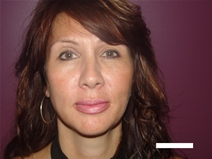 Eyelid Surgery After Photo by Moneer Jaibaji, MD; Coronado, CA - Case 20334