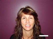 Eyelid Surgery Before Photo by Moneer Jaibaji, MD; Coronado, CA - Case 20334