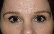 Eyelid Surgery After Photo by Moneer Jaibaji, MD; Coronado, CA - Case 20335