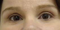 Eyelid Surgery Before Photo by Moneer Jaibaji, MD; Coronado, CA - Case 20335