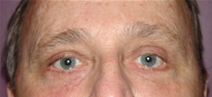 Eyelid Surgery After Photo by Moneer Jaibaji, MD; Coronado, CA - Case 20337