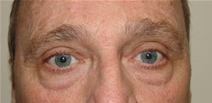 Eyelid Surgery Before Photo by Moneer Jaibaji, MD; Coronado, CA - Case 20337
