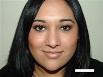 Rhinoplasty After Photo by Moneer Jaibaji, MD; Coronado, CA - Case 20338