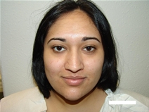 Rhinoplasty Before Photo by Moneer Jaibaji, MD; Coronado, CA - Case 20338