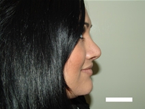 Rhinoplasty After Photo by Moneer Jaibaji, MD; Coronado, CA - Case 20338