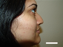 Rhinoplasty Before Photo by Moneer Jaibaji, MD; Coronado, CA - Case 20338