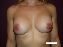 Breast Augmentation After Photo by Moneer Jaibaji, MD; Coronado, CA - Case 20339