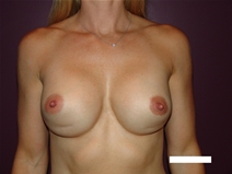 Breast Augmentation Before Photo by Moneer Jaibaji, MD; Coronado, CA - Case 20339