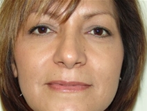 Rhinoplasty After Photo by Moneer Jaibaji, MD; Coronado, CA - Case 20341