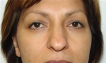 Rhinoplasty Before Photo by Moneer Jaibaji, MD; Coronado, CA - Case 20341