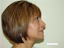 Rhinoplasty After Photo by Moneer Jaibaji, MD; Coronado, CA - Case 20341