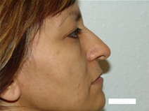 Rhinoplasty Before Photo by Moneer Jaibaji, MD; Coronado, CA - Case 20341