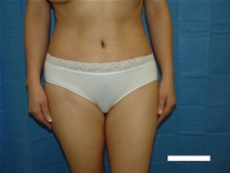 Tummy Tuck After Photo by Moneer Jaibaji, MD; Coronado, CA - Case 20342