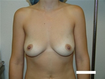 Breast Augmentation Before Photo by Moneer Jaibaji, MD; Coronado, CA - Case 20345