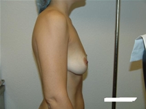 Breast Augmentation Before Photo by Moneer Jaibaji, MD; Coronado, CA - Case 20345