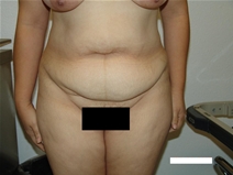Tummy Tuck Before Photo by Moneer Jaibaji, MD; Coronado, CA - Case 20375