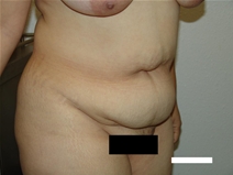 Tummy Tuck Before Photo by Moneer Jaibaji, MD; Coronado, CA - Case 20375