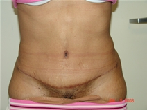 Tummy Tuck After Photo by Moneer Jaibaji, MD; Coronado, CA - Case 20377