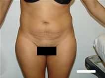 Tummy Tuck Before Photo by Moneer Jaibaji, MD; Coronado, CA - Case 20377