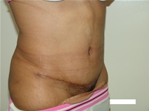Tummy Tuck After Photo by Moneer Jaibaji, MD; Coronado, CA - Case 20377