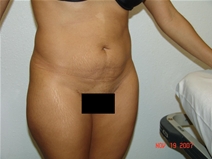 Tummy Tuck Before Photo by Moneer Jaibaji, MD; Coronado, CA - Case 20377