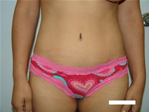 Tummy Tuck After Photo by Moneer Jaibaji, MD; Coronado, CA - Case 20378