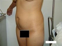 Tummy Tuck Before Photo by Moneer Jaibaji, MD; Coronado, CA - Case 20378