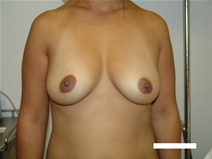 Breast Augmentation Before Photo by Moneer Jaibaji, MD; Coronado, CA - Case 20380