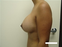 Breast Augmentation After Photo by Moneer Jaibaji, MD; Coronado, CA - Case 20380
