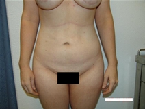 Body Contouring Before Photo by Moneer Jaibaji, MD; Coronado, CA - Case 20382