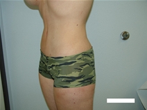 Body Contouring After Photo by Moneer Jaibaji, MD; Coronado, CA - Case 20382