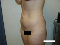Body Contouring Before Photo by Moneer Jaibaji, MD; Coronado, CA - Case 20382