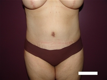 Tummy Tuck After Photo by Moneer Jaibaji, MD; Coronado, CA - Case 20404