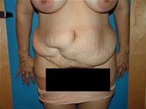 Tummy Tuck Before Photo by Moneer Jaibaji, MD; Coronado, CA - Case 20404
