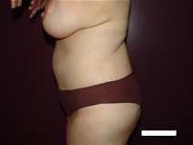 Tummy Tuck After Photo by Moneer Jaibaji, MD; Coronado, CA - Case 20404