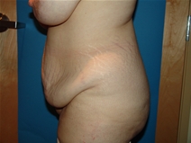 Tummy Tuck Before Photo by Moneer Jaibaji, MD; Coronado, CA - Case 20404