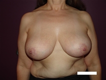 Breast Reduction After Photo by Moneer Jaibaji, MD; Coronado, CA - Case 20405