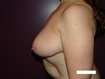 Breast Reduction After Photo by Moneer Jaibaji, MD; Coronado, CA - Case 20405