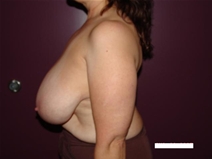 Breast Reduction Before Photo by Moneer Jaibaji, MD; Coronado, CA - Case 20405